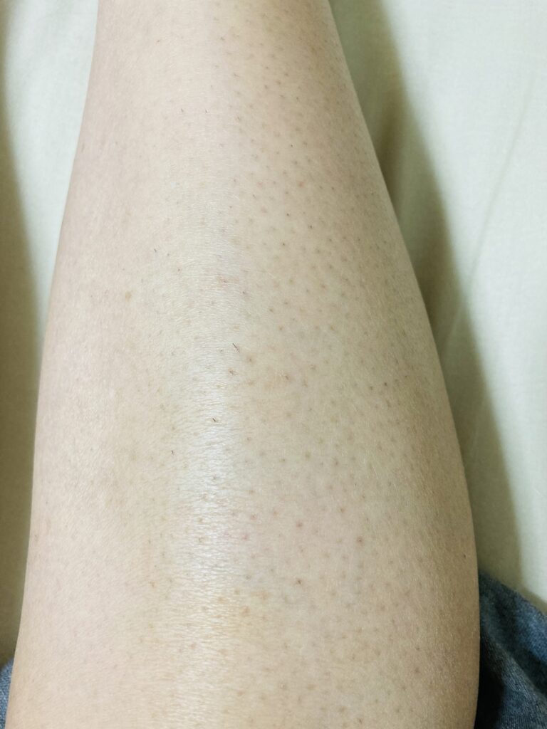 ケノン6回目