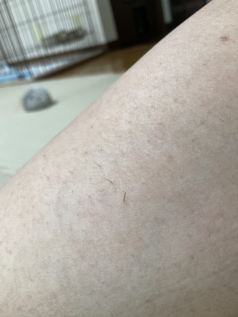 ケノン脱毛のあし